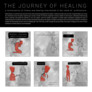 2. Preis: The Journey of Healing | © Christeven Cohen · Lawrence Nobel, Indonesien